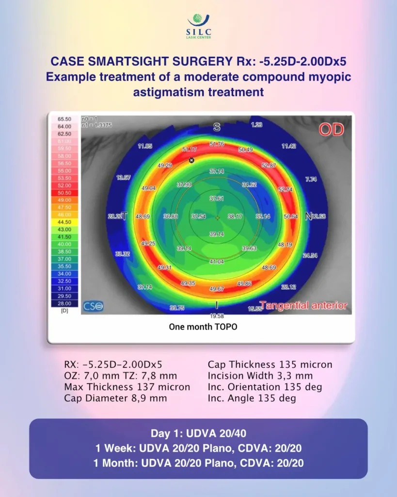 smartsight lenticule extraction sic lasik